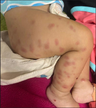 Multiple well-defined tender subcutaneous nodules over bilateral thighs and legs.